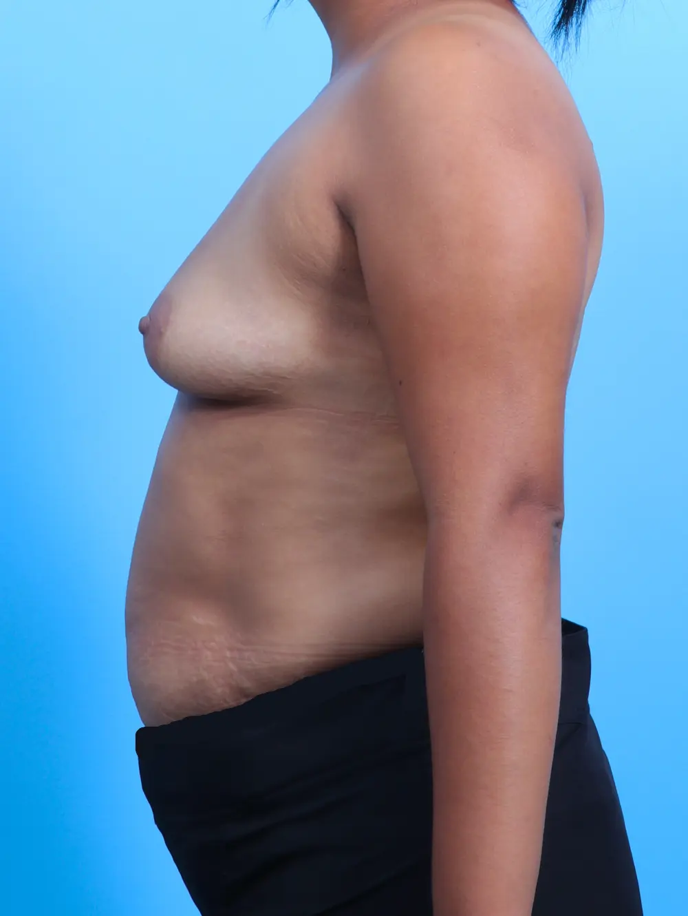 Breast Augmentation Patient Photo - Case 25650 - before view-2