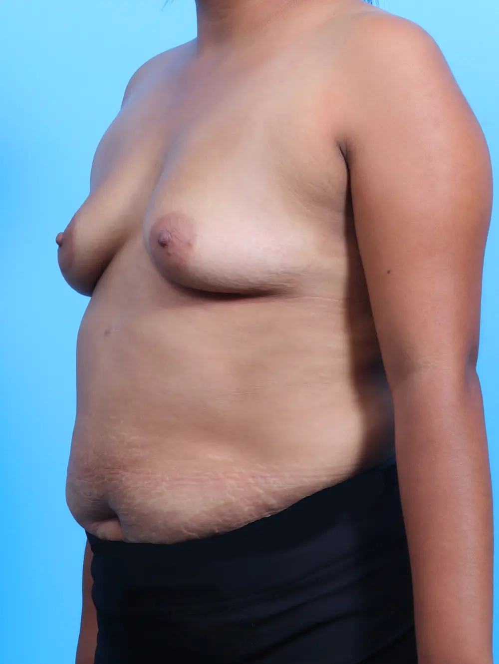 Breast Augmentation Patient Photo - Case 25650 - before view-1