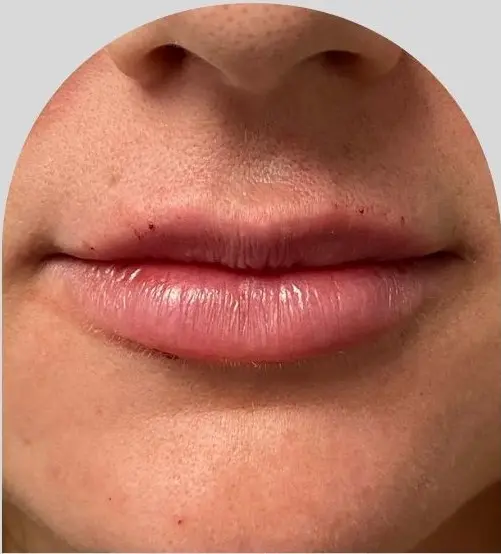 Lip Fillers - Case 25664 - After