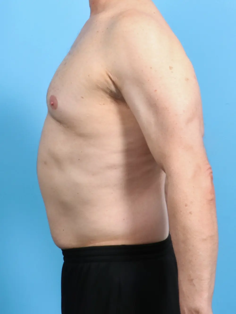 Gynecomastia Patient Photo - Case 25732 - before view-2