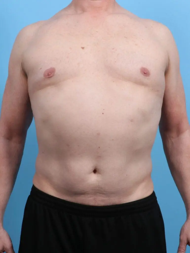 Gynecomastia - Case 25732 - After