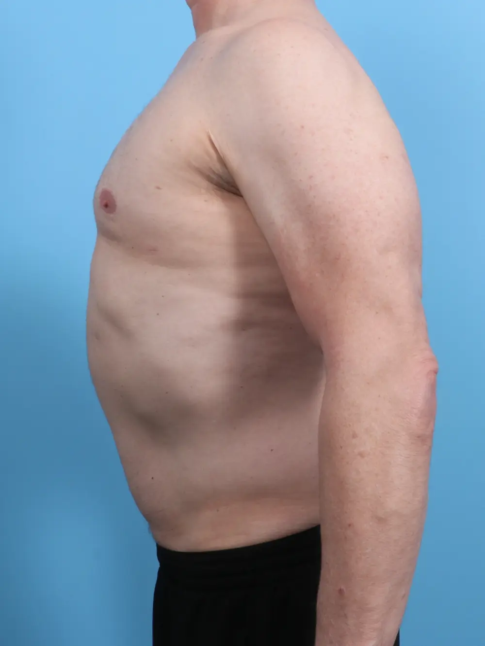 Gynecomastia Patient Photo - Case 25732 - after view-2