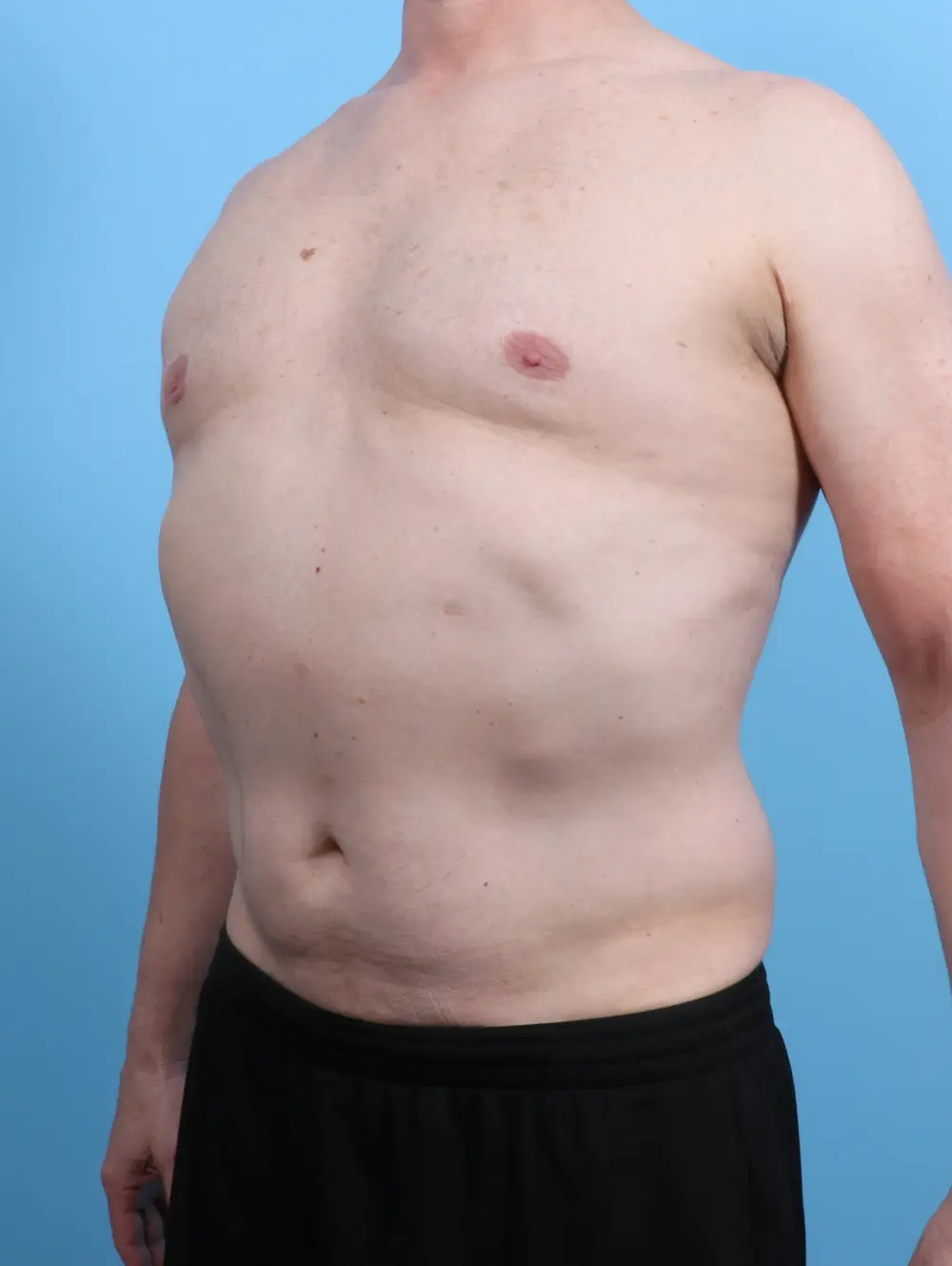 Gynecomastia Patient Photo - Case 25732 - after view-1