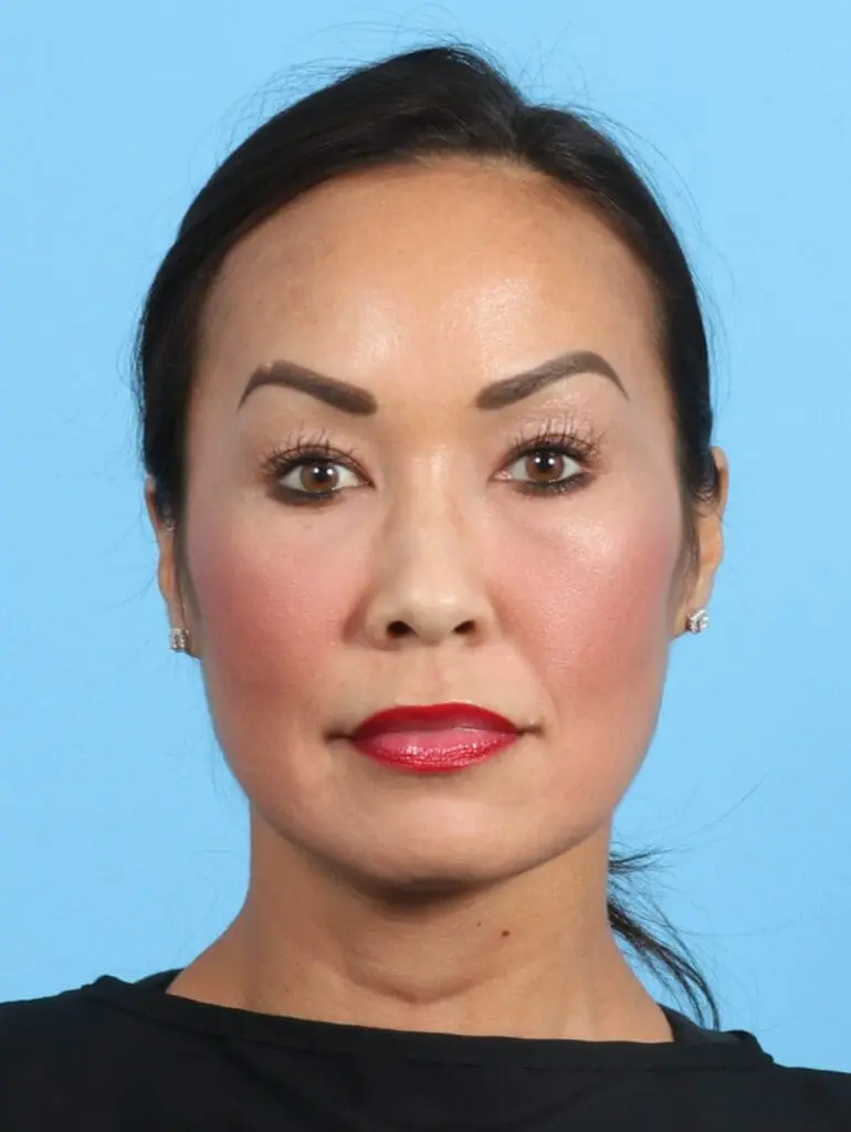 Eyelid Surgery - Case 25765 - Before