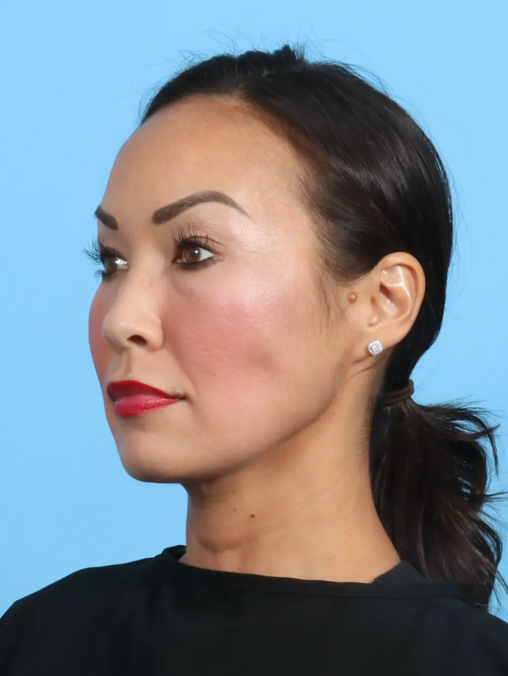 Eyelid Surgery Patient Photo - Case 25765 - before view-1