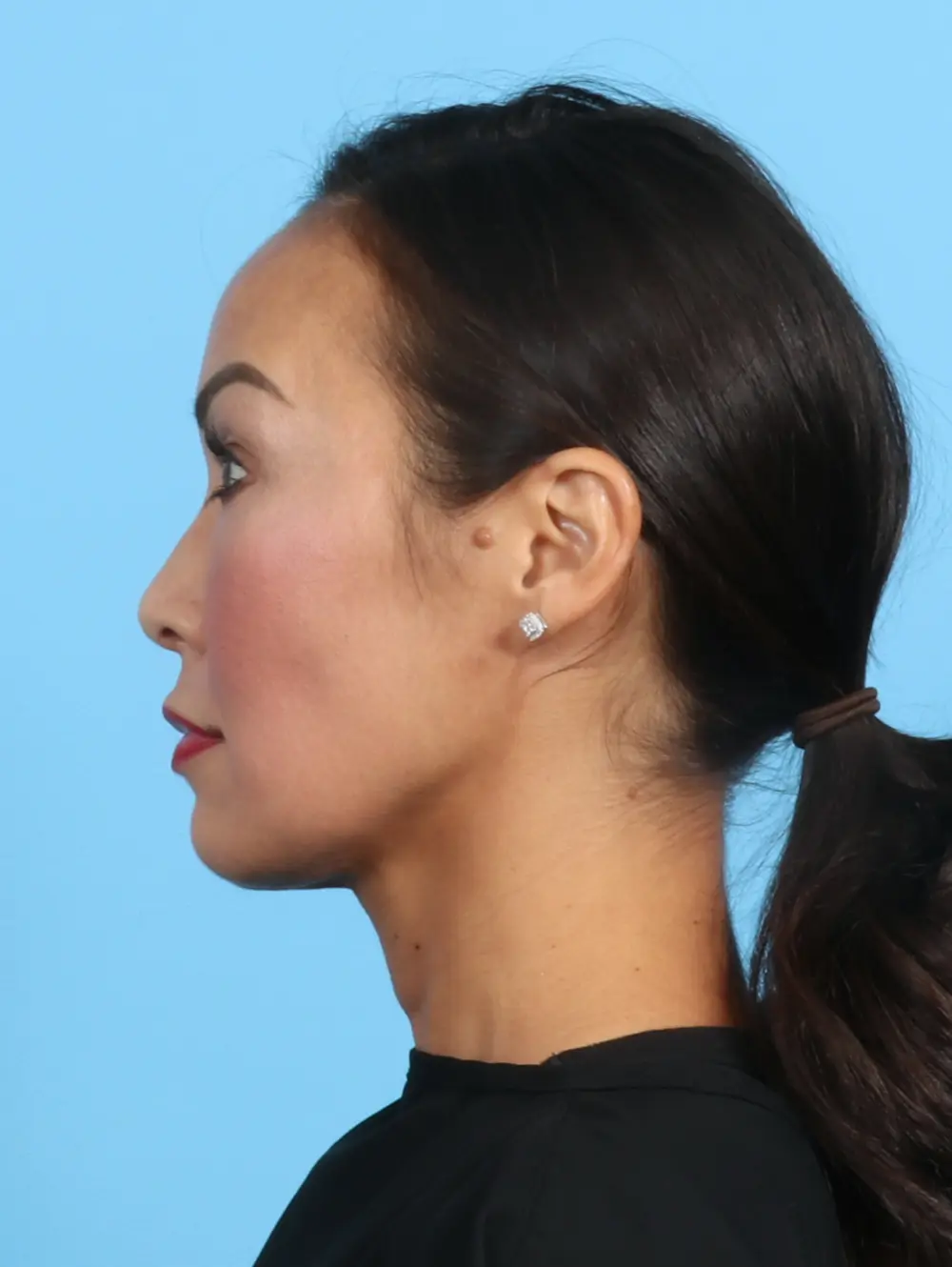Eyelid Surgery Patient Photo - Case 25765 - before view-2