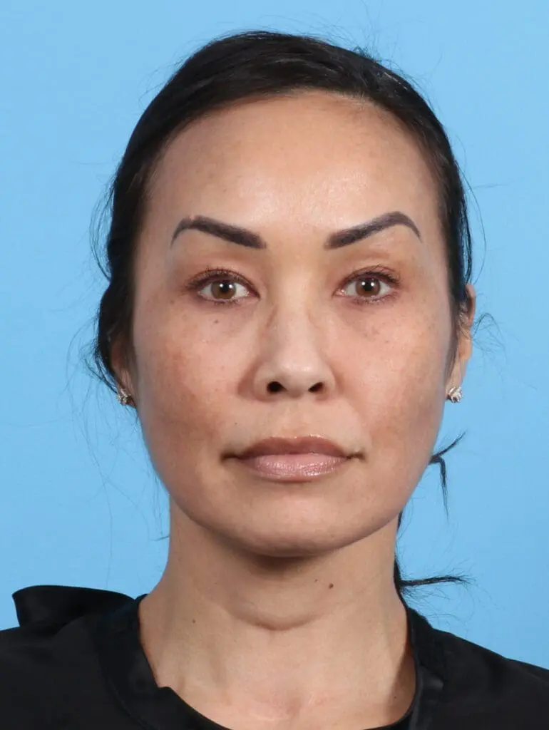 Eyelid Surgery - Case 25765 - After