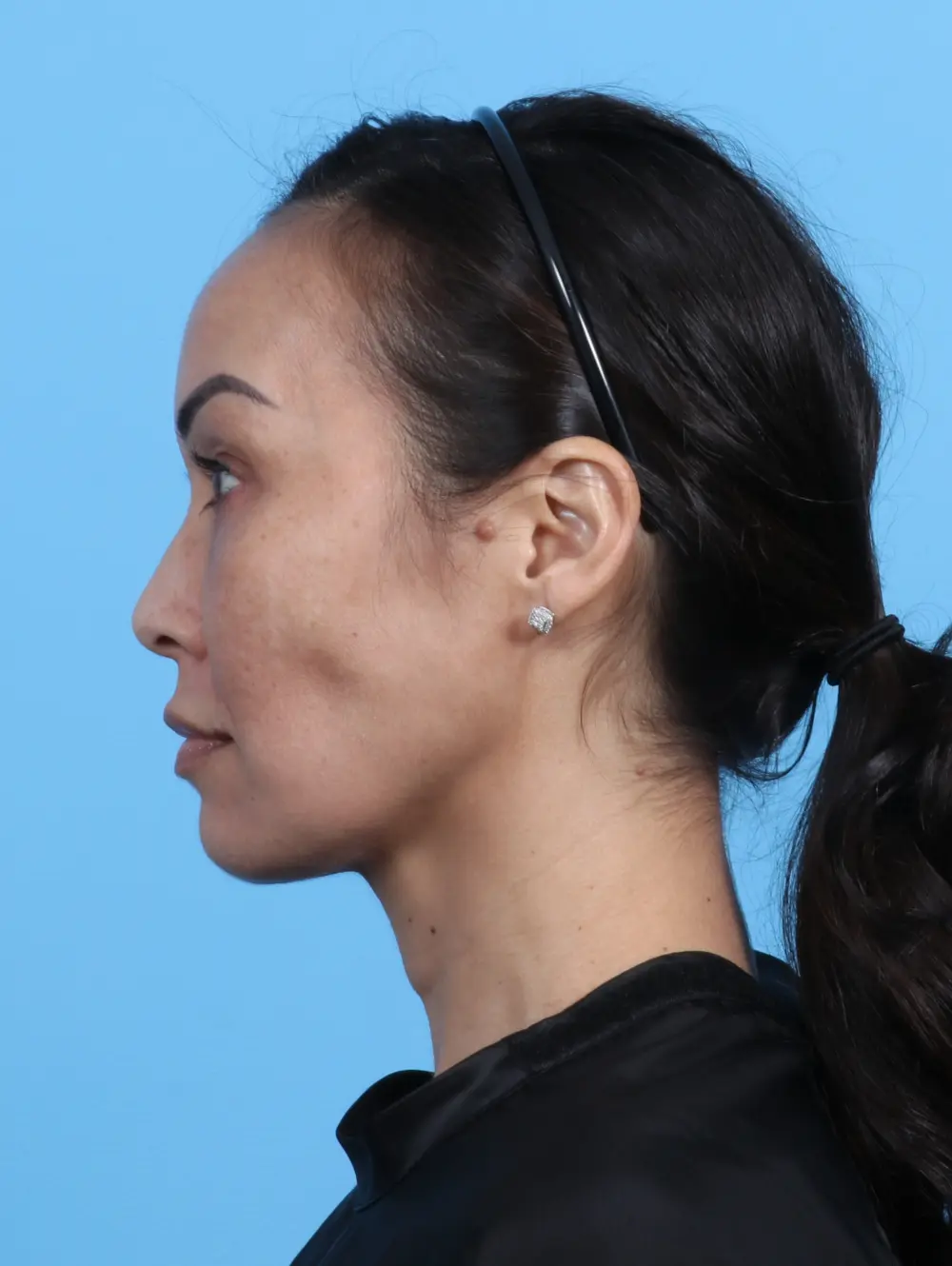 Eyelid Surgery Patient Photo - Case 25765 - after view-2