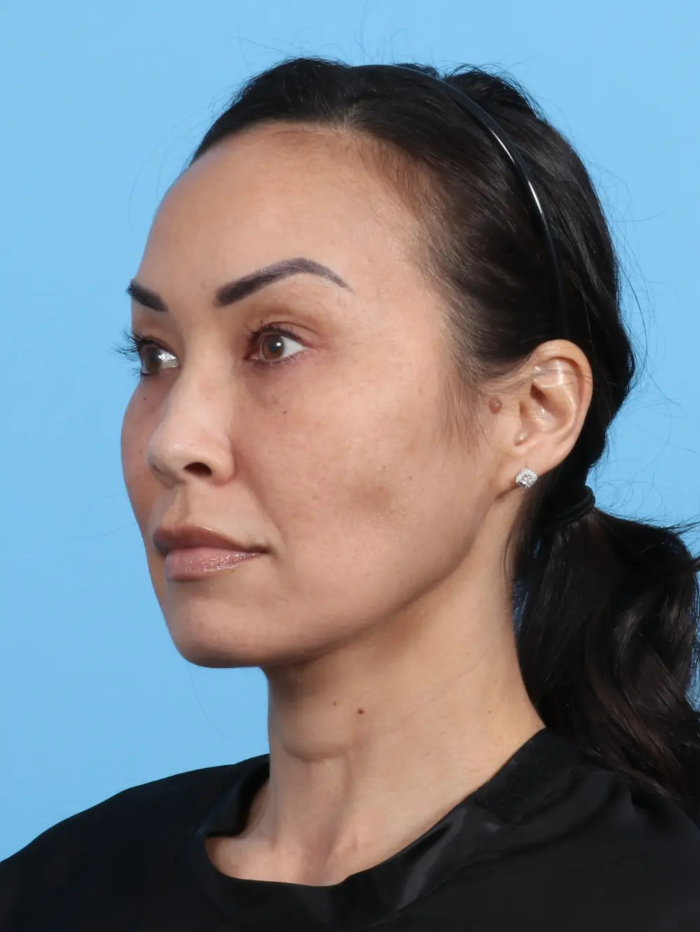 Eyelid Surgery Patient Photo - Case 25765 - after view-1