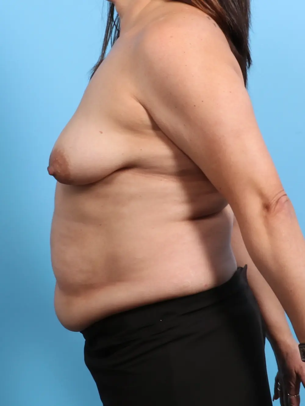 Breast Lift/Reduction with Implants Patient Photo - Case 25773 - before view-2
