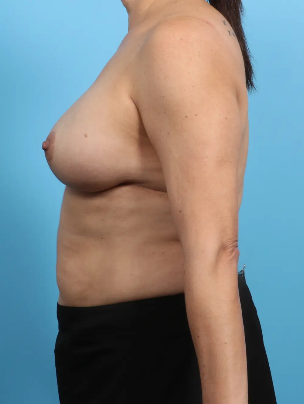 Breast Lift/Reduction with Implants Patient Photo - Case 25773 - after view-2