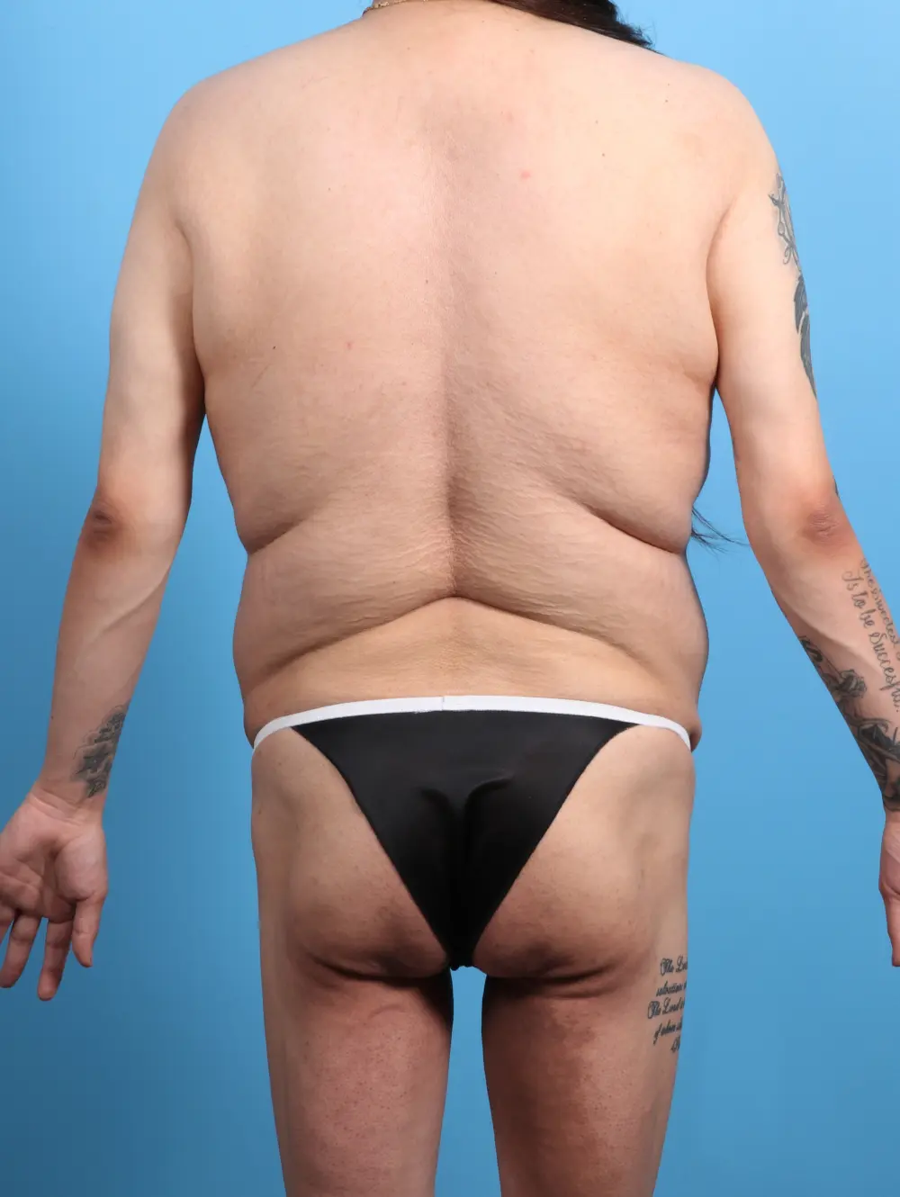 Mommy Makeover Patient Photo - Case 25781 - before view-3