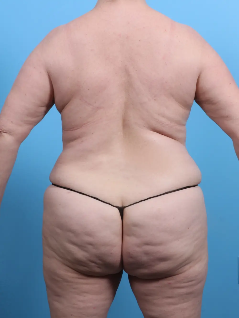 Breast Lift/Reduction w/o Implants Patient Photo - Case 25791 - after view-3