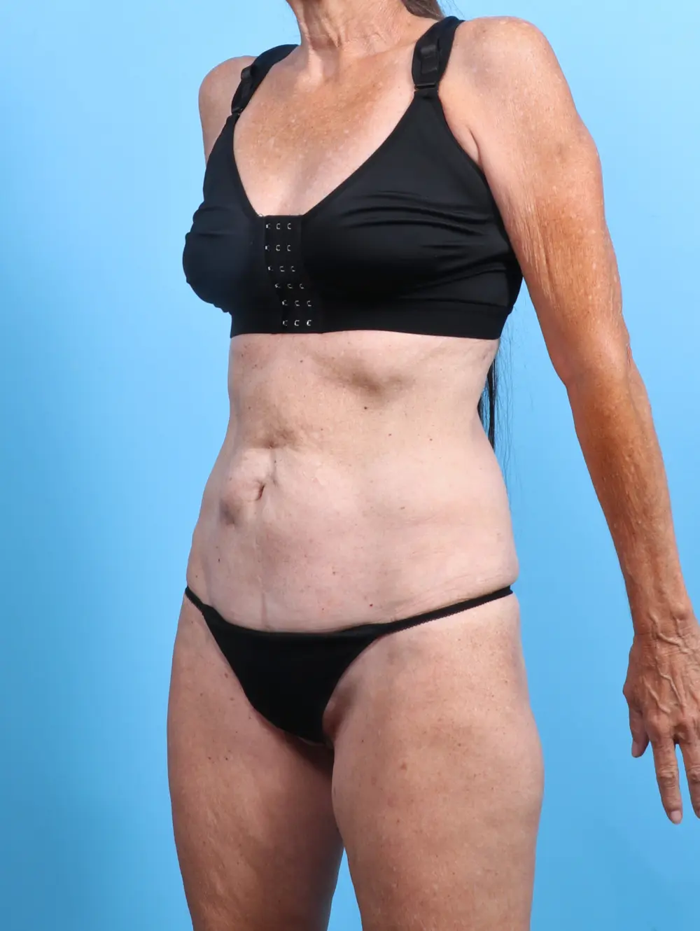 Tummy Tuck Patient Photo - Case 25801 - before view-1