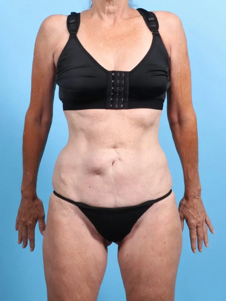 Tummy Tuck - Case 25801 - Before