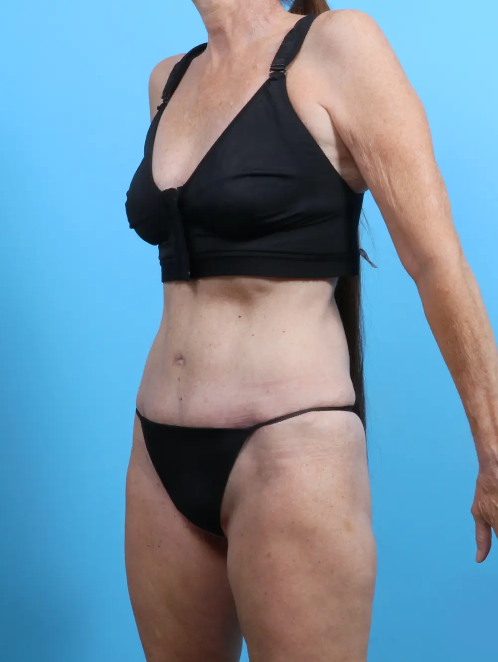 Tummy Tuck Patient Photo - Case 25801 - after view-1