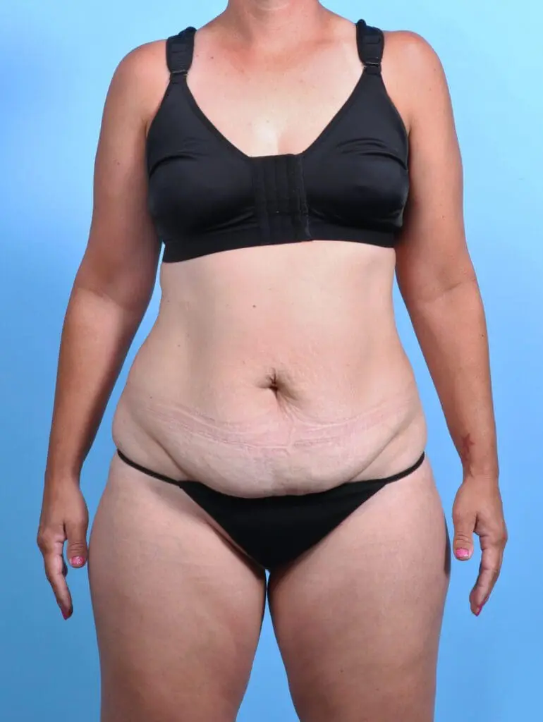 Tummy Tuck - Case 25809 - Before