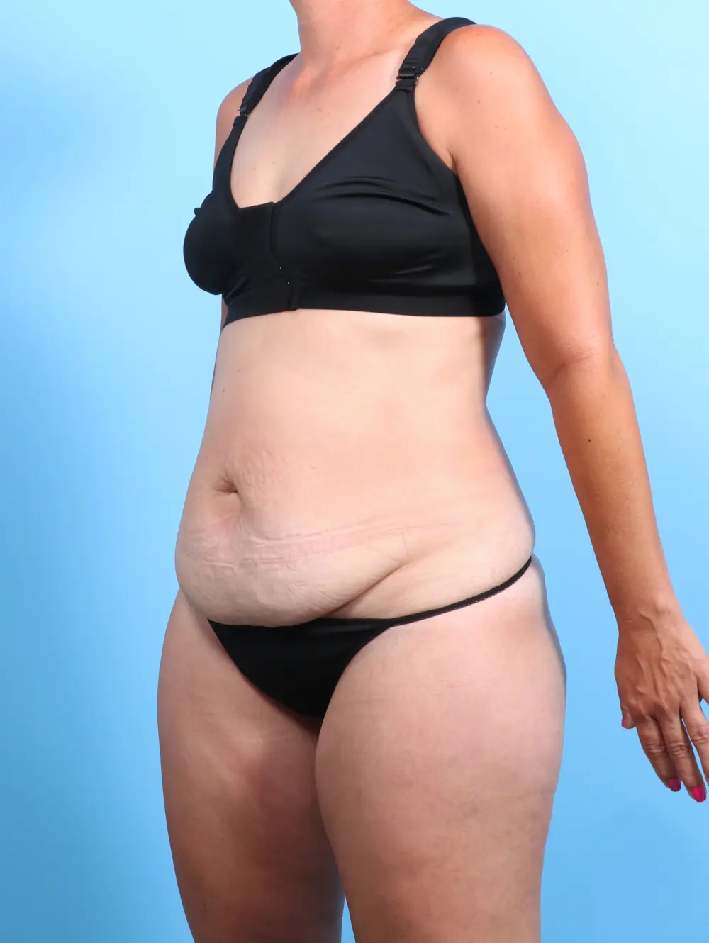 Tummy Tuck Patient Photo - Case 25809 - before view-1