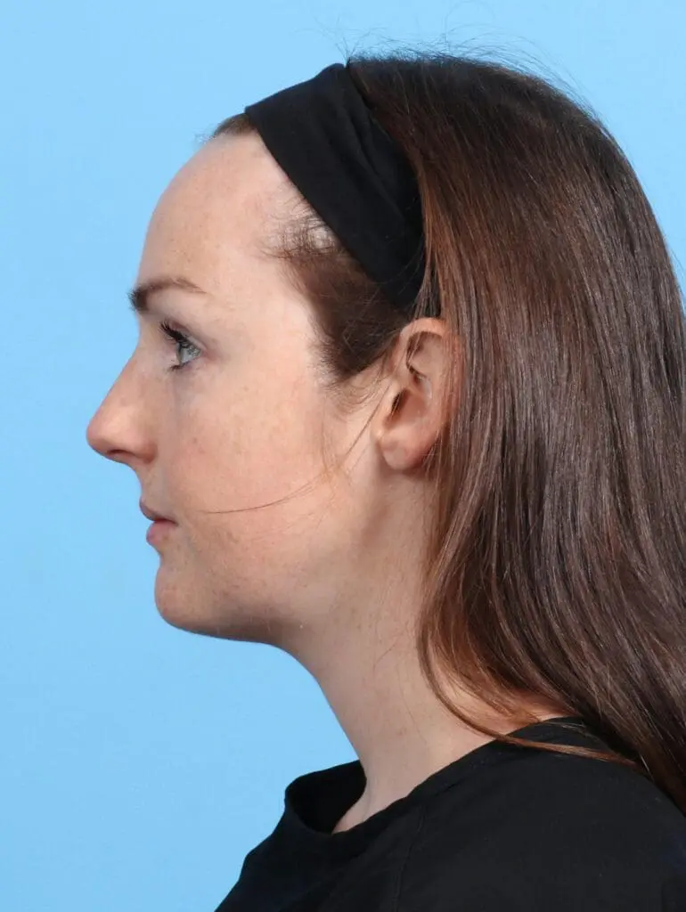 Rhinoplasty - Case 25817 - Before
