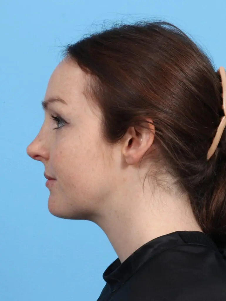 Rhinoplasty - Case 25817 - After