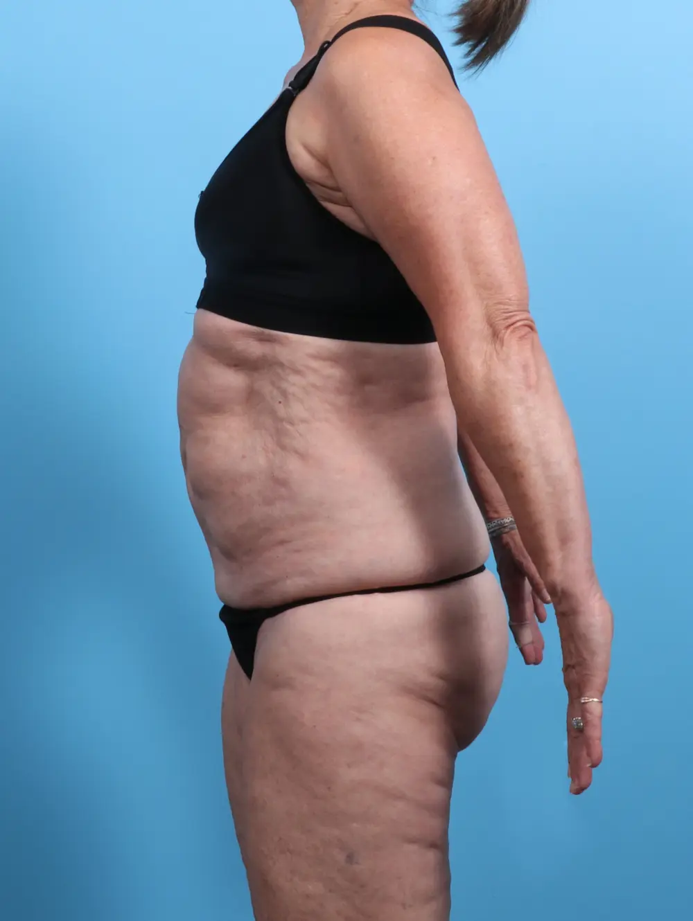 Tummy Tuck Patient Photo - Case 25833 - before view-2