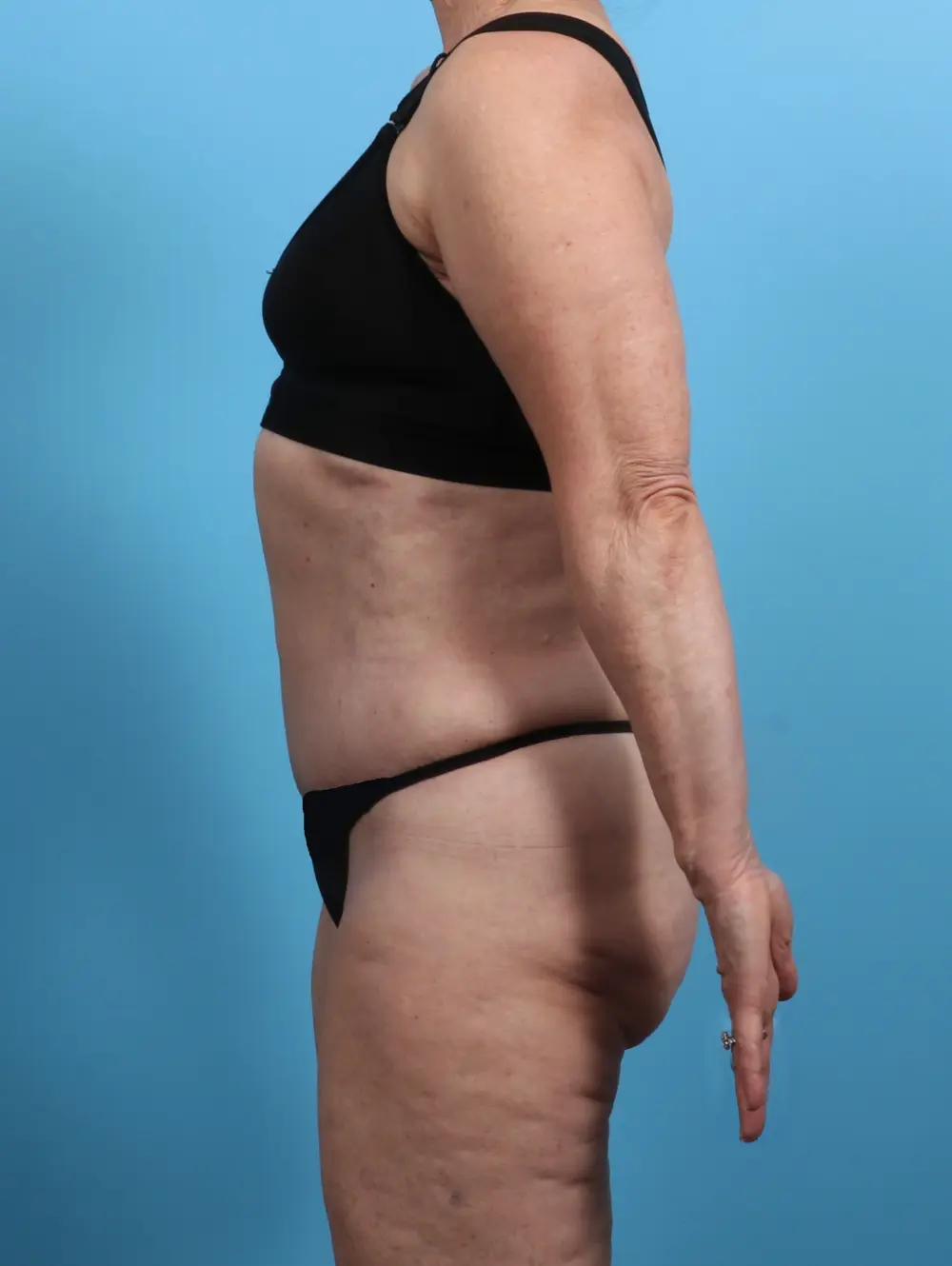 Tummy Tuck Patient Photo - Case 25833 - after view-2