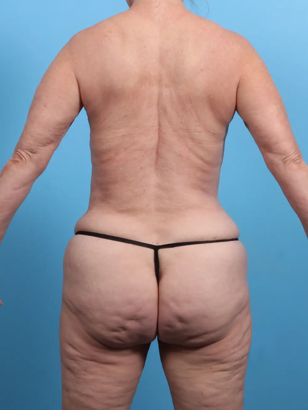 Tummy Tuck Patient Photo - Case 25833 - after view-3