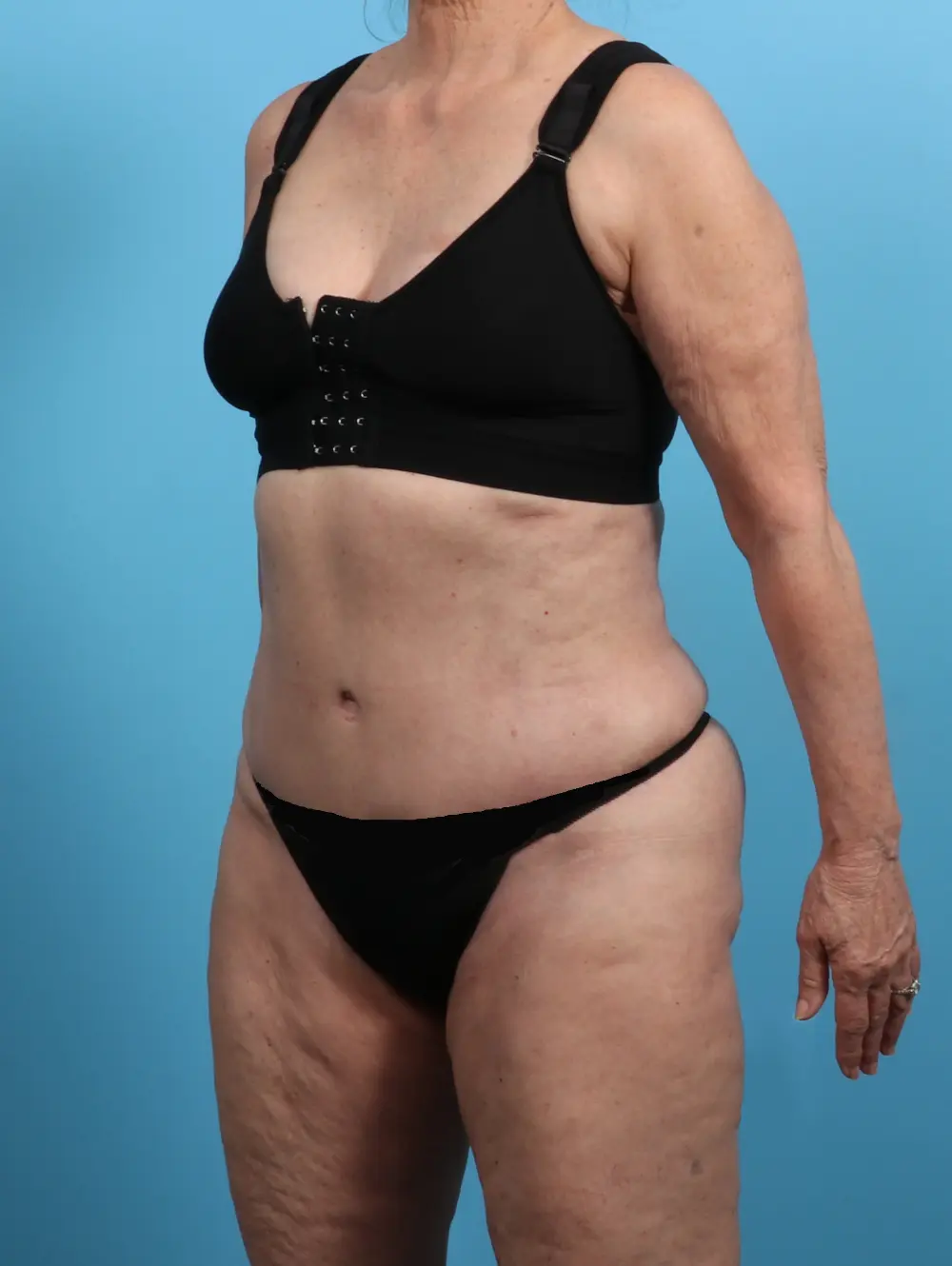 Tummy Tuck Patient Photo - Case 25833 - after view-1