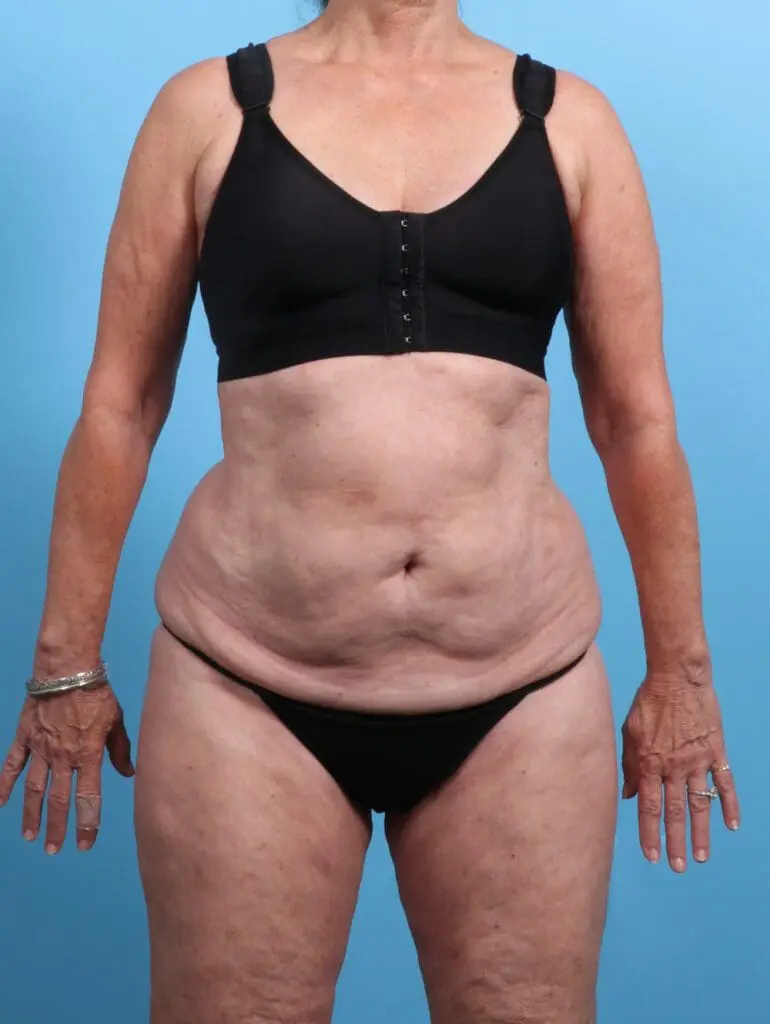 Tummy Tuck - Case 25833 - Before