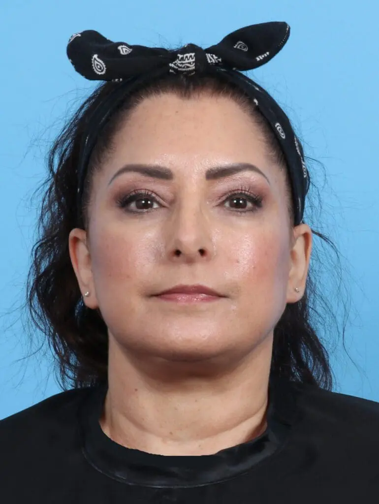Facelift / Neck Lift - Case 25843 - After