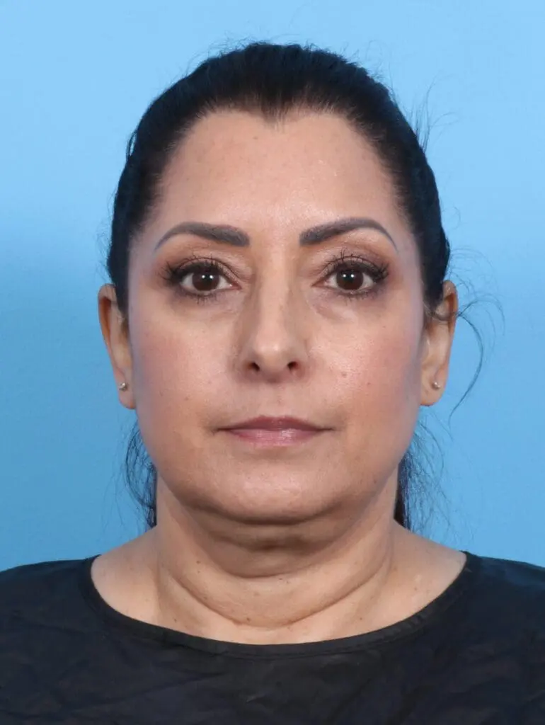 Facelift / Neck Lift - Case 25843 - Before