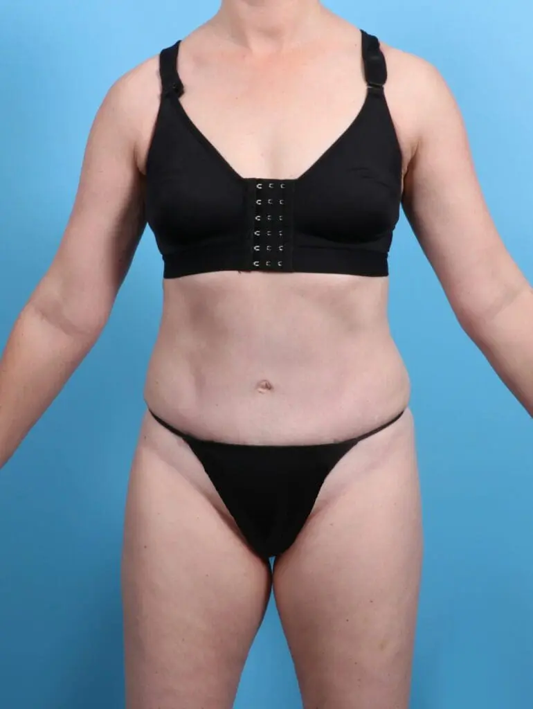 Tummy Tuck - Case 25865 - After