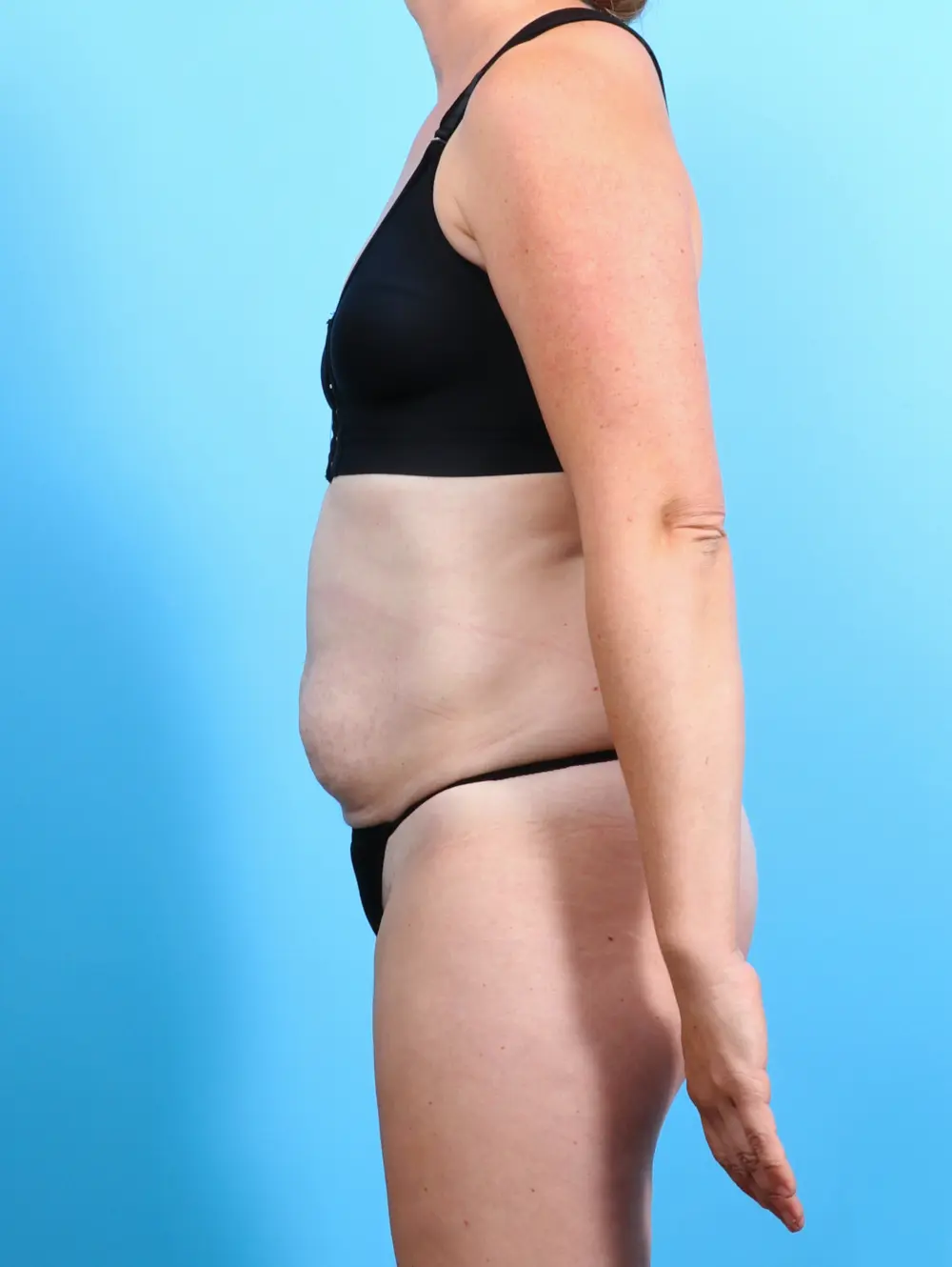 Tummy Tuck Patient Photo - Case 25865 - before view-2
