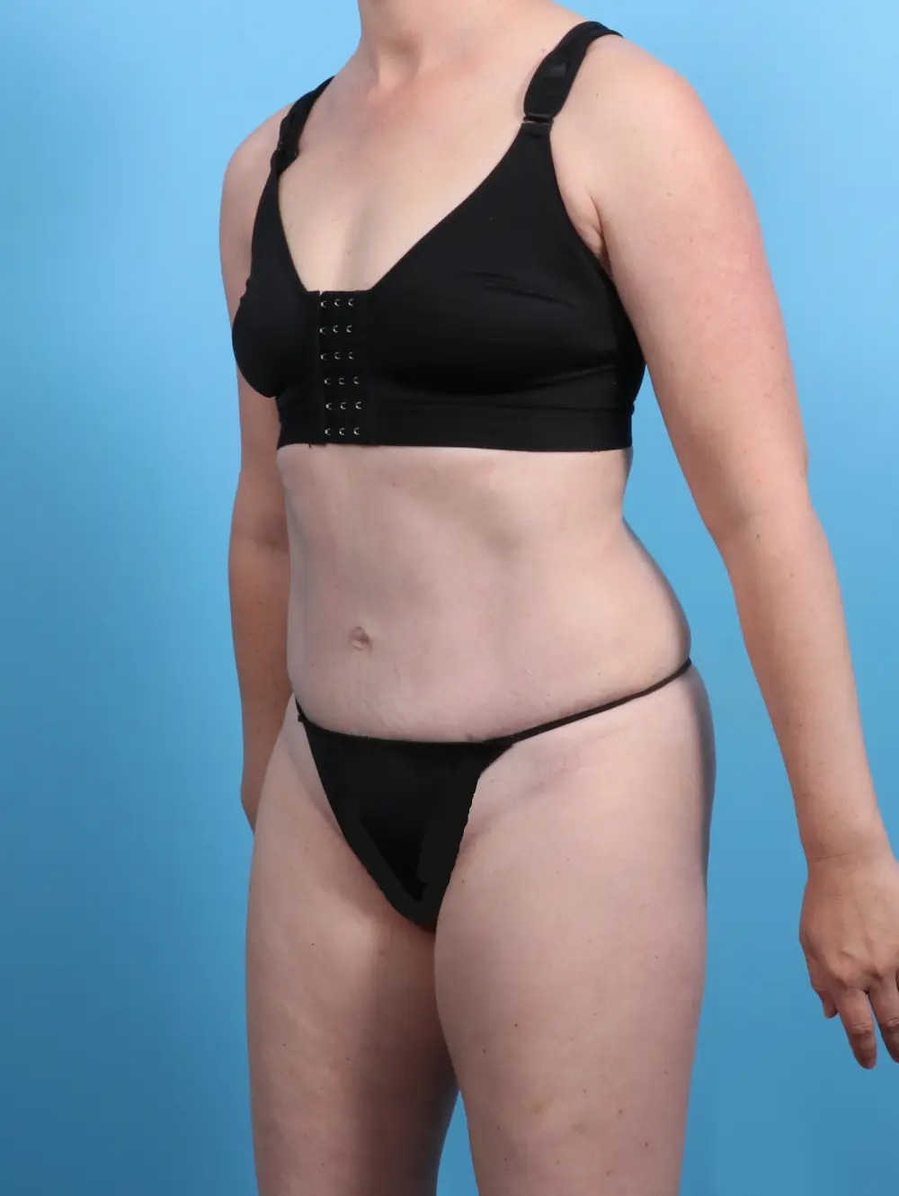 Tummy Tuck Patient Photo - Case 25865 - after view-1
