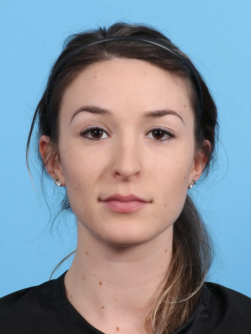 Rhinoplasty Patient Photo - Case 25881 - after view-2