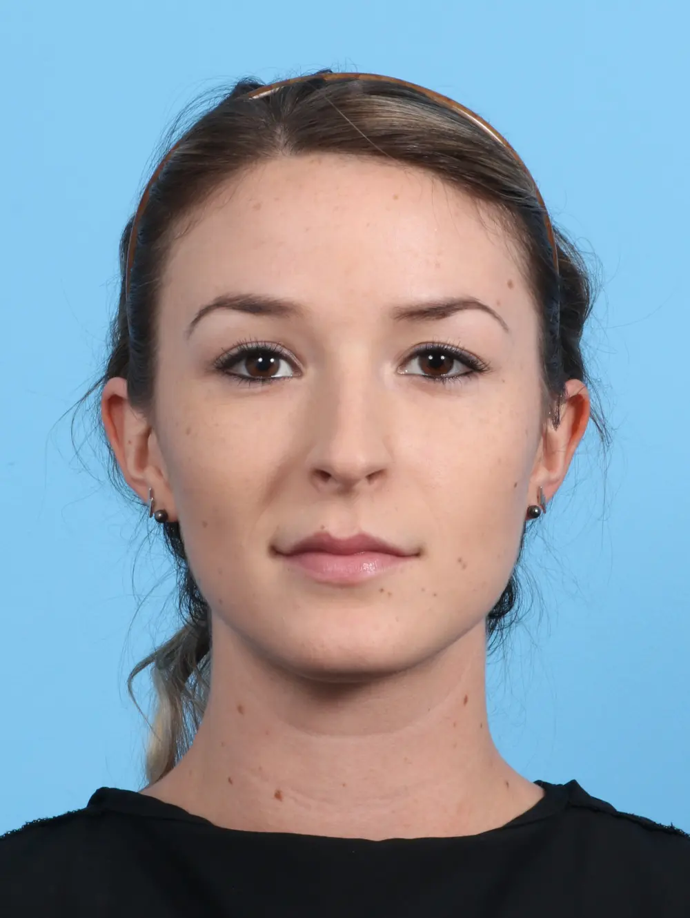 Rhinoplasty Patient Photo - Case 25881 - before view-2