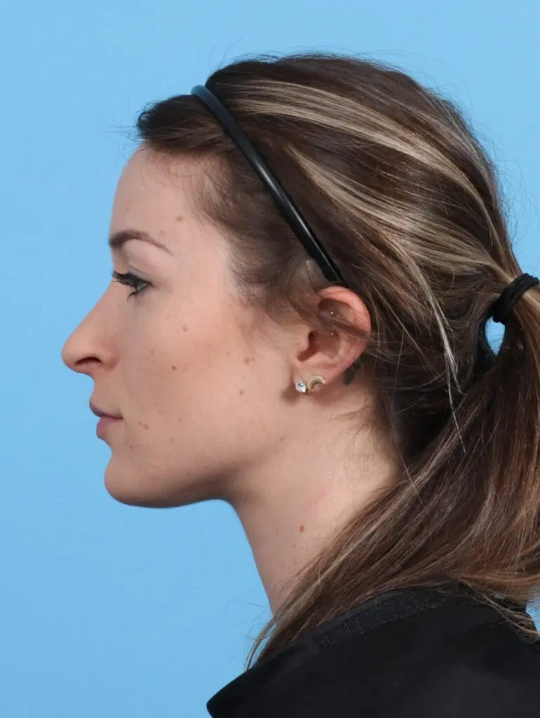 Rhinoplasty - Case 25881 - After