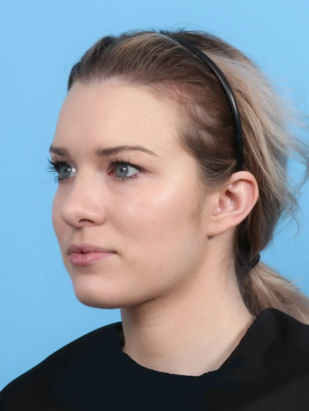 Rhinoplasty Patient Photo - Case 26164 - after view-1