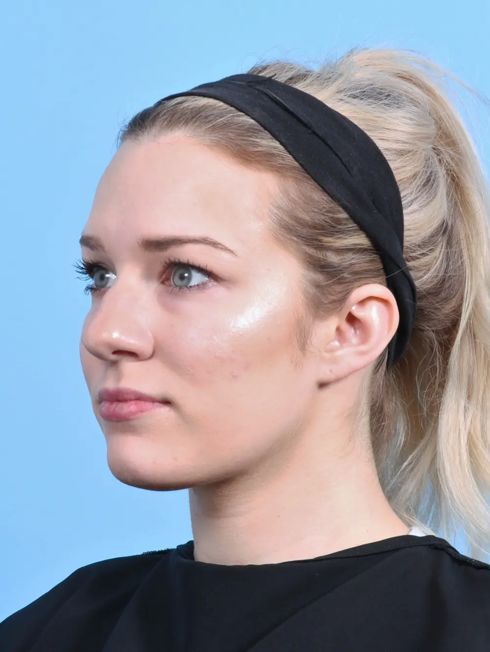 Rhinoplasty Patient Photo - Case 26164 - before view-1