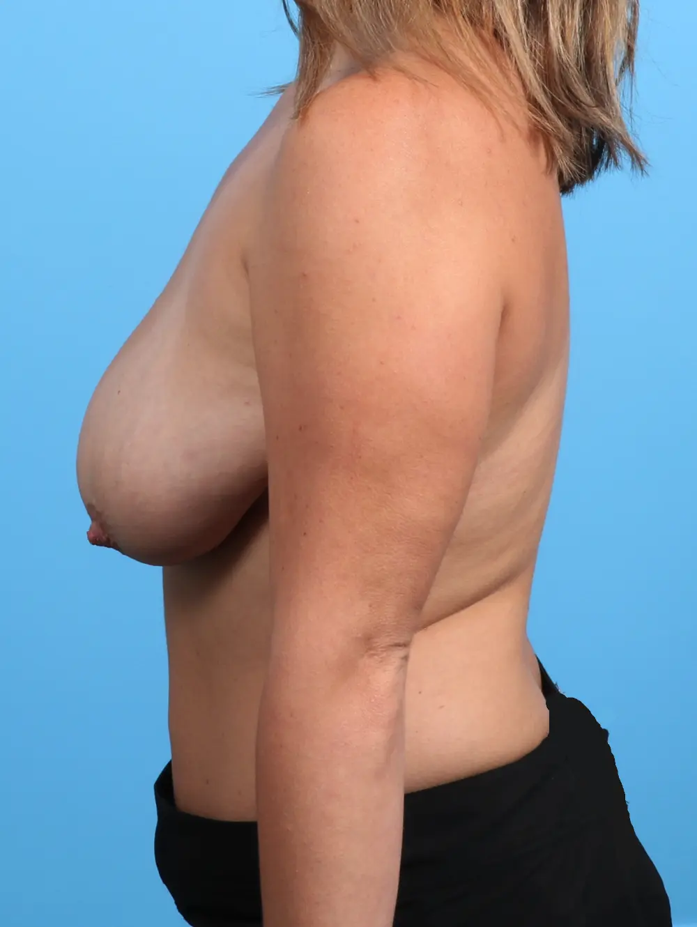 Breast Lift/Reduction with Implants Patient Photo - Case 26189 - before view-2