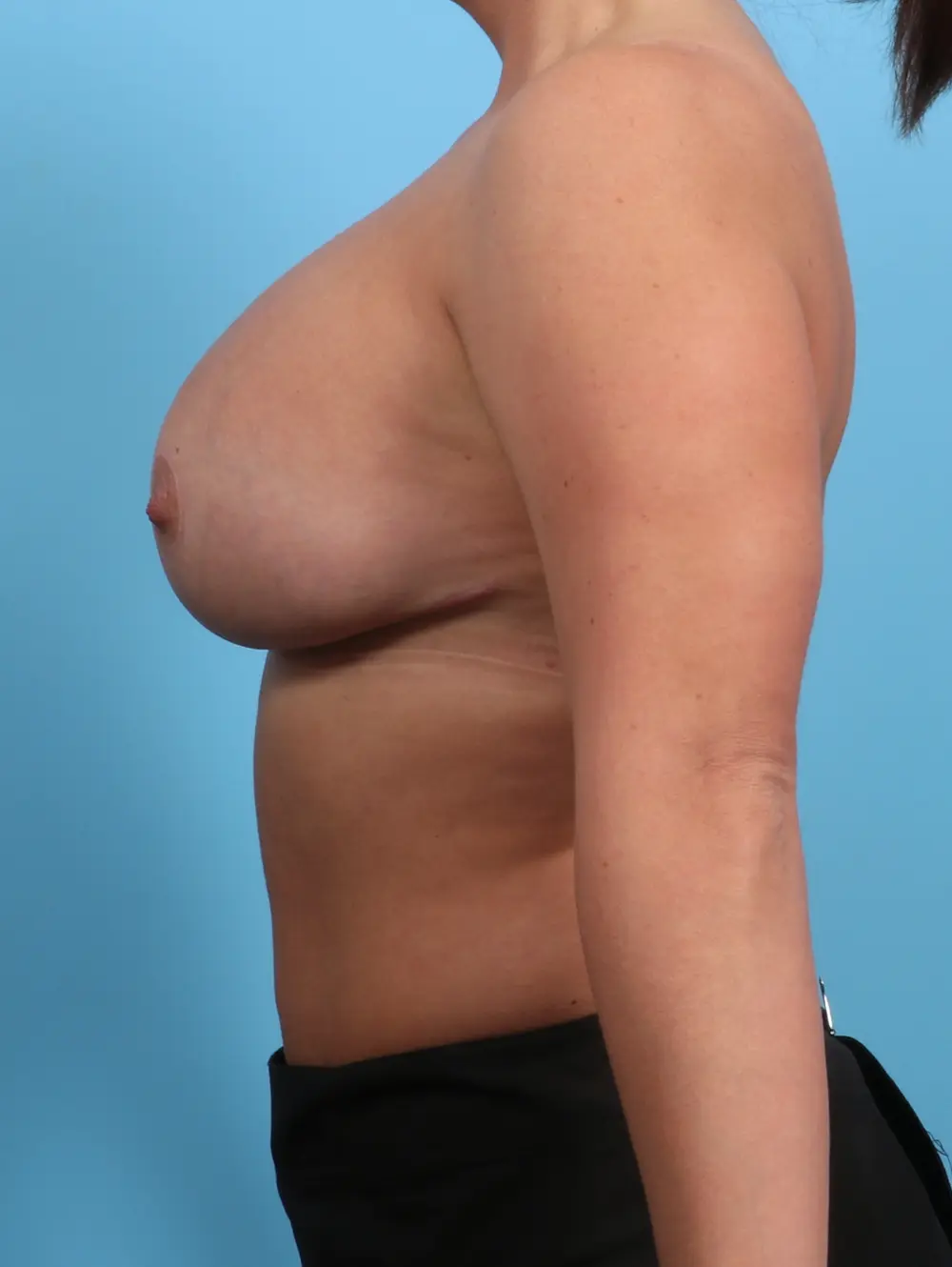 Breast Lift/Reduction with Implants Patient Photo - Case 26189 - after view-2