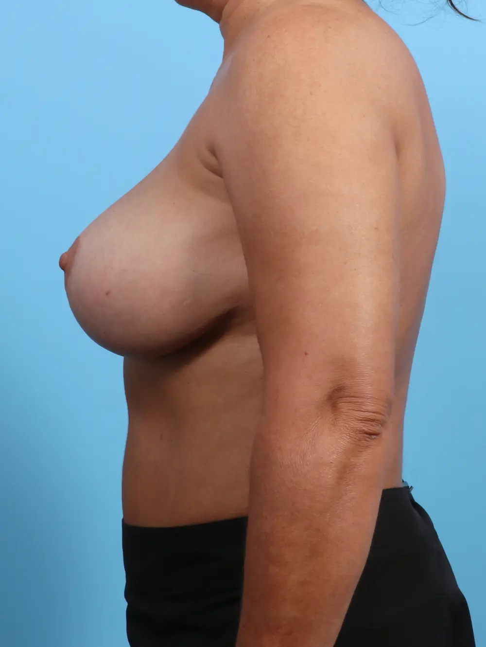 Breast Implant Revision Patient Photo - Case 26213 - after view-2