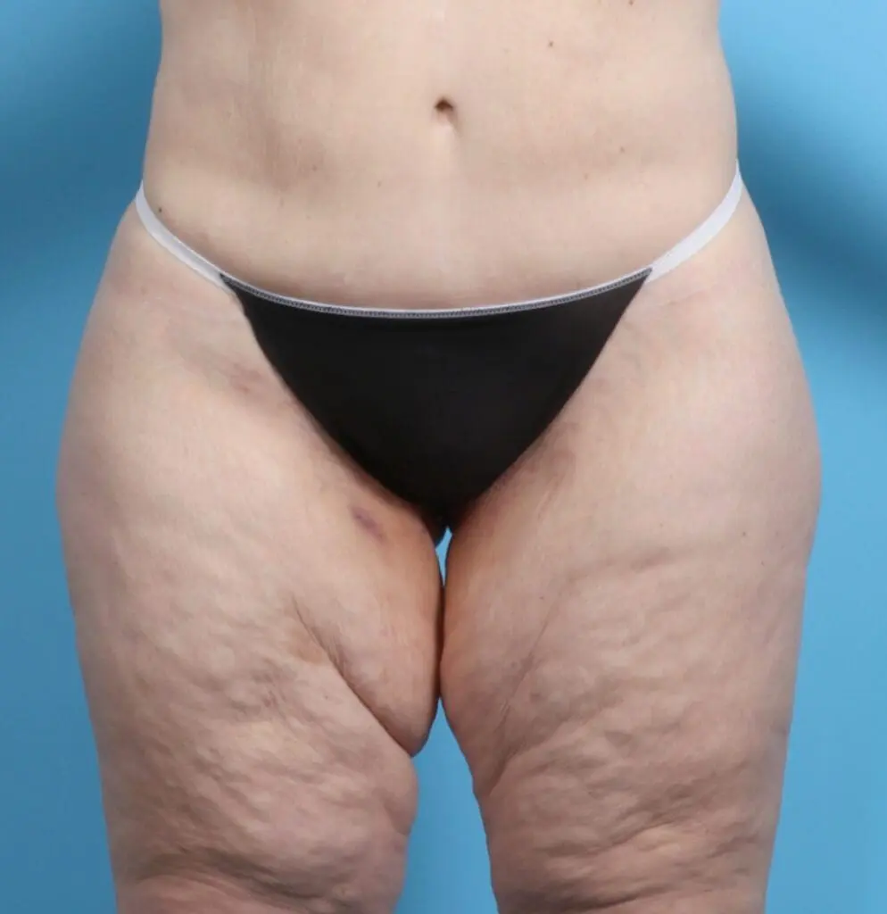 After Weight Loss - Case 26229 - Before