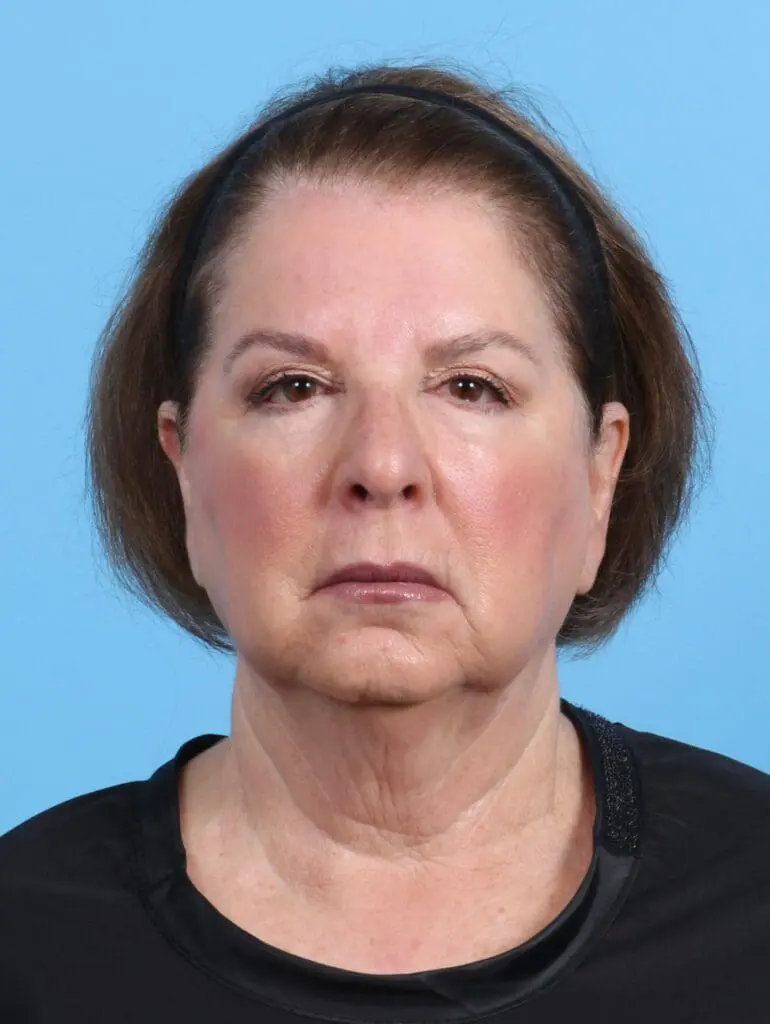 Brow Lift - Case 26244 - Before