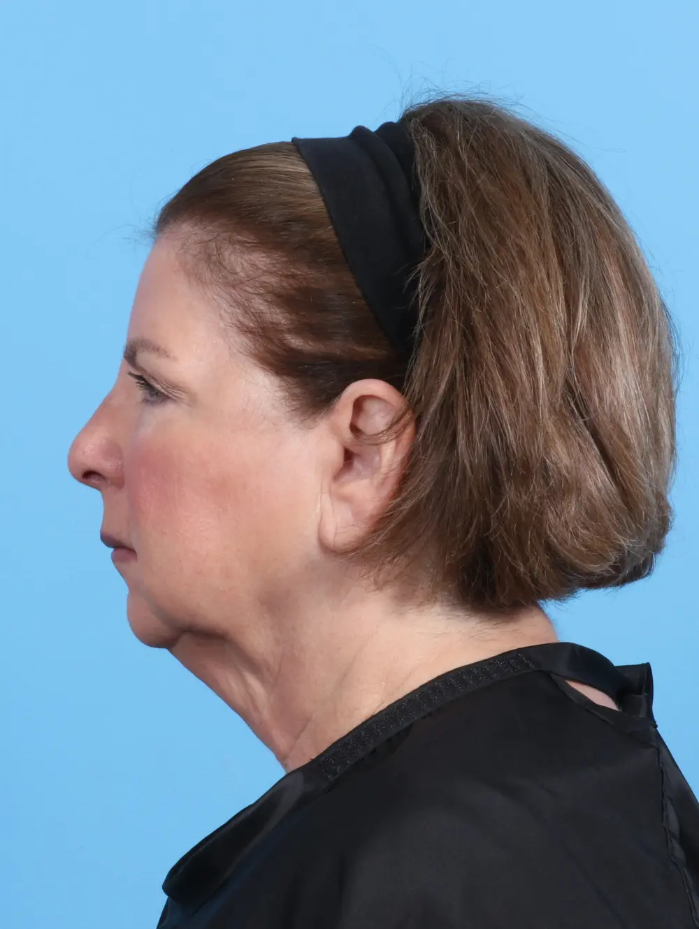 Brow Lift Patient Photo - Case 26244 - before view-2