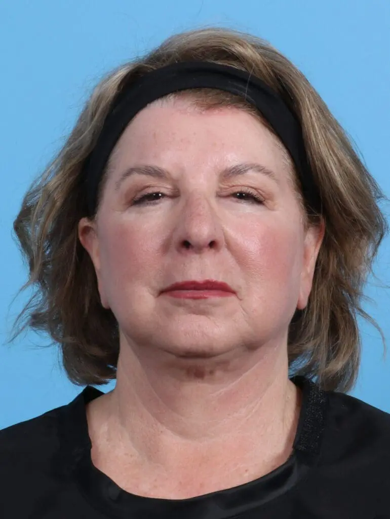 Brow Lift - Case 26244 - After