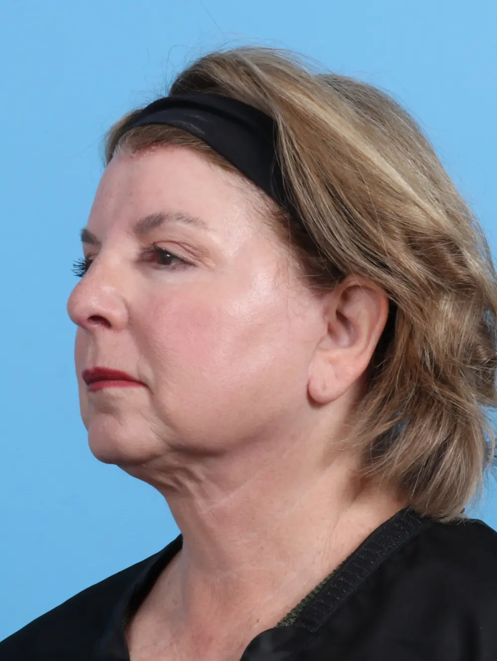Brow Lift Patient Photo - Case 26244 - after view-1