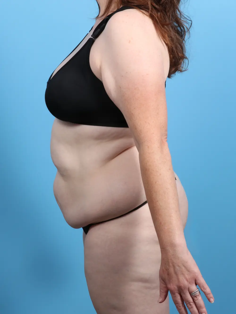 Tummy Tuck Patient Photo - Case 26252 - before view-2