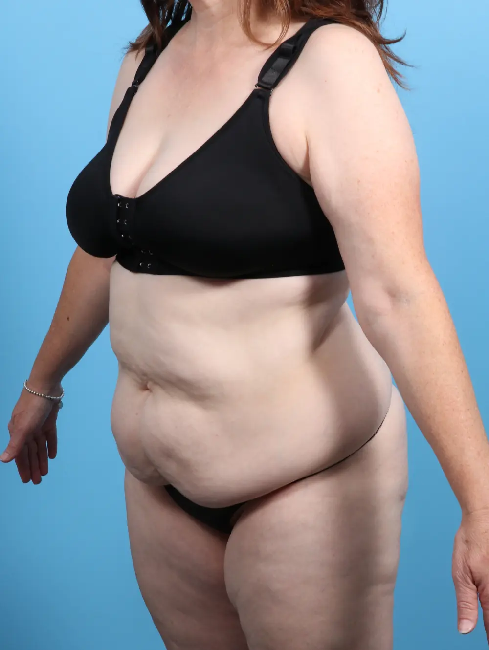 Tummy Tuck Patient Photo - Case 26252 - before view-1