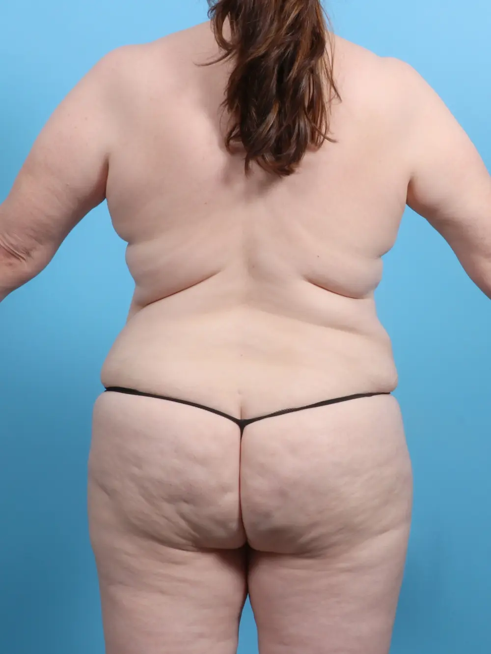 Tummy Tuck Patient Photo - Case 26252 - after view-3